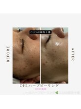 クリア 麻布十番(CLEAR)/肌荒れ　乾燥　毛穴ケア　吸引