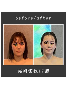 サロン ド ハーモニー美/コルギ♪面長改善・小顔額丸く等