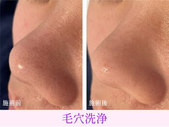 オーシャンブルー 日田店/毛穴の黒ずみケア(毛穴洗浄)