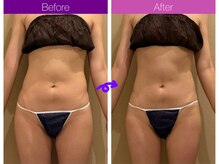 クレヴィア バイ サイバーエステ(CREBIA)/体重より見た目重視]の方にも♪