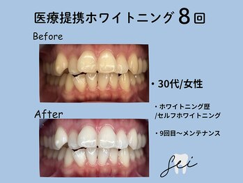 セイ(sei)/ホワイトニングビフォーアフター