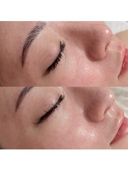 オンド(OND)/バリア機能低下によるざらつきに