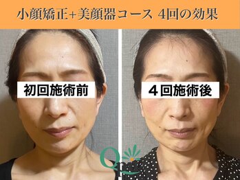 キュープ 表参道店(Qpu)/美顔器モニターコース4回の変化