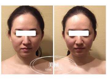 美極 銀座店/銀座/小顔コルギ/小顔矯正