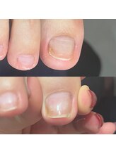 セラキュアネイル(Theracure nail)/足の爪が1ヶ月でのびました