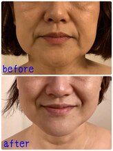 モテ肌 小顔コルギサロン カムトゥルー(come true)/3か月でこの変化！！