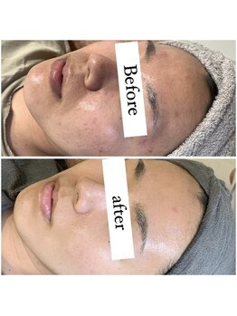 サロンメロウ 大牟田店(salon mellow)/剥けないハーブピーリング 