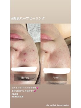 ア ルフレ(A.reflet)/before、after
