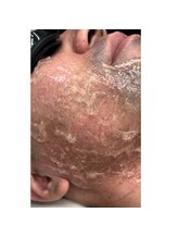 メロウ(mellow)/脱毛直後から毛が飛び出てくる☆