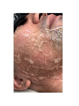 メロウ(mellow)/脱毛直後から毛が飛び出てくる☆