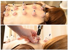 ティーケア 八王子(T-CARE)/カッピング/強い凝りの解消に