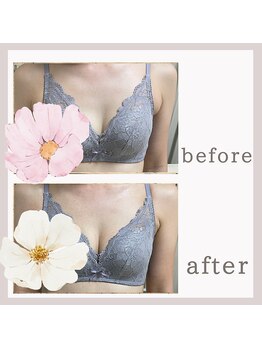 アリサナ(Arisana)/症例写真　バスト　葛西