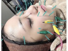 セントラル鍼灸院リラクシー(Re:laxy)/パルスの刺激は頭:顔気持ち良い