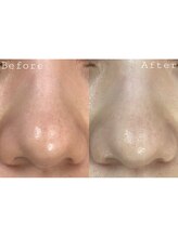 オアシス 一宮(Oasis)/毛穴洗浄で黒ずみ&角質除去！