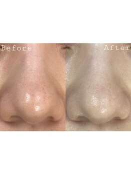 オアシス 一宮(Oasis)/毛穴洗浄で黒ずみ&角質除去!