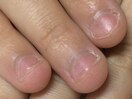 深爪縦長補正ビフォー☆