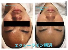 エヴァーグレース 横浜店/頑固なニキビにもアプローチ♪