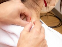 ほねつぎ総社 はりきゅう接骨院/施術風景【鍼灸】