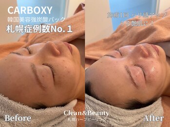 クリーンアンドビューティ 札幌(Clean&Beauty)/韓国強炭酸パック札幌症例数No.1