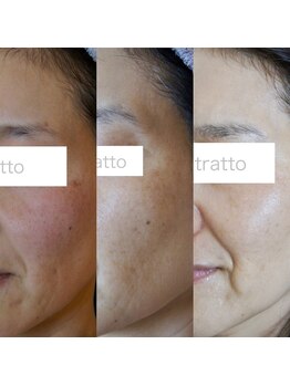 トラット エステアンドアイズ(tratto)/50代　お客様症例写真