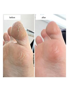 ケアプラス(care plus)/足裏角質ケア