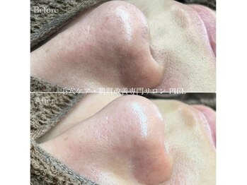 ピエル 北千住店(PIEL)/毛穴エクストラクション