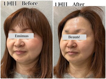 エミマス ボーテ(Emimas Beaute’)/４０代半ば 小顔矯正＆毛穴洗浄