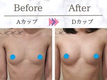 メディカルサロン エム エム エム 心斎橋本店(M.M.M)/【バストアップ例】　A→Dカップ