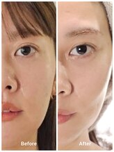 アン 銀座(ann)/メソスキンカラー