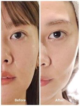 アン 銀座(ann)/メソスキンカラー