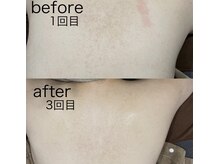 ルミエール 札幌大通parkside店の雰囲気（20代後半、背中肌荒れ黒ずみで来店。施術3回ですべすべな素肌に）