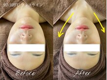 セラピエージ/小顔・引き締め・リフトアップ◎