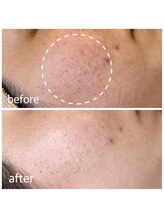 ねね整骨院 エヌシャープ(N#)/赤みが落ち着きました☆