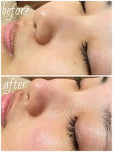 ベルシア ボディアンドアイラッシュ(Belsia)/毛穴洗浄&モデリングパック