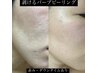 ≪DT有りハーブピーリング・ダウンタイム説明≫