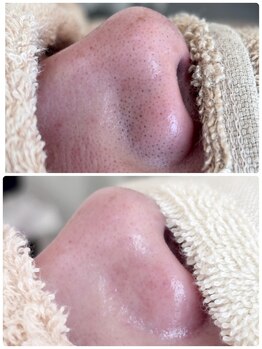 セレンディー(serendi)/毛穴洗浄