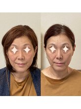 小顔22 ボルティ 赤坂支店(Bolty)/【悩み】たるみ