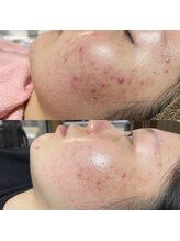 ティグレ 岡山店(TIGRE)/光フェイシャル（ニキビ予防）