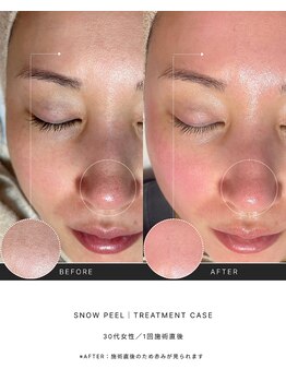 スキンラウンジ(SKIN LOUNGE)/韓国肌管理｜PDRN雪花ピール