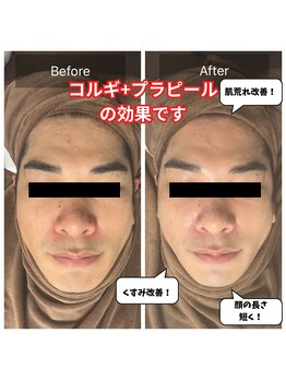 チョアチョア 札幌すすきの店(CHOA-CHOA)/男性も肌管理の時代！