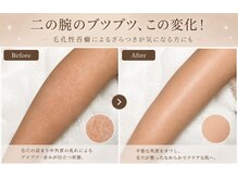 salon KARENA 【７/２０ NEW OPEN（予定）】 /二の腕のブツブツに！