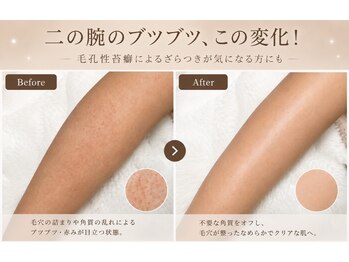 salon KARENA 【７/２０ NEW OPEN（予定）】 /二の腕のブツブツに！
