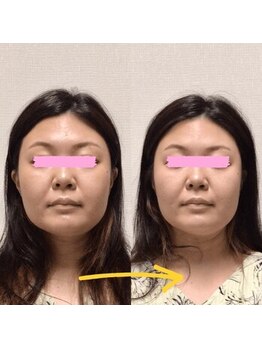 アレイズ/小顔矯正コース