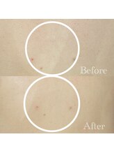 ケア ラウンジ ザ ファースト(THE F1RST)/背中改善＊ビフォーアフター