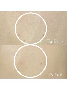 ケア ラウンジ ザ ファースト(THE F1RST)/背中改善＊ビフォーアフター