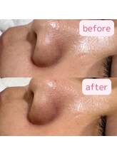 エトワール 横浜馬車道店(ETOILE)/肌質改善|毛穴ケア