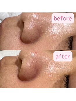 エトワール 横浜馬車道店(ETOILE)/肌質改善|毛穴ケア・メイク崩れ