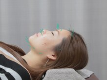 マカナ接骨院(Makana接骨院)/電気を流す美容鍼