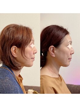 小顔22 ボルティ 赤坂支店(Bolty)/【悩み】たるみ