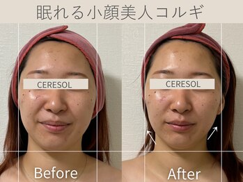 セレソル(CERESOL)/〈20代女性〉施術1回での効果＊